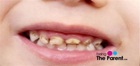 Cavities In Baby Teeth Pictures Tamatha Bull