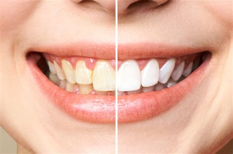 Can Teeth Whitening Damage Your Teeth Read More Here