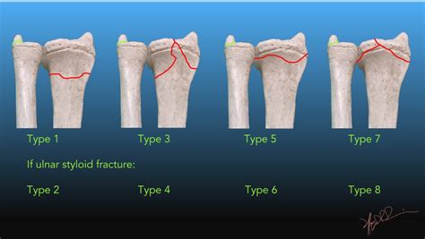 Frykman Classification Of Distal Radial Fractures Uw Emergency Radiology