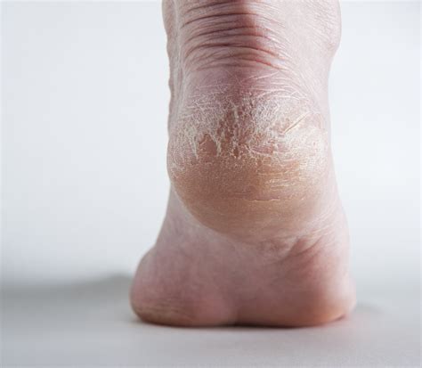 Dry Elbows Rough Heels Mario Badescu Skin Care Blog