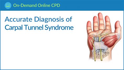 Accurate Diagnosis Of Carpal Tunnel Syndromeuk Carpal Tunnel Syndrome 22 23 Clinical Cpd Couk