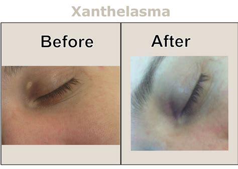 Xanthelasma Removal Altrincham Manchester