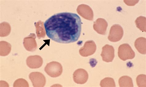 Reactive Lymphocytes Cells And Smears