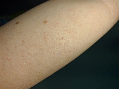 Сыпь на руках у ребёнка 9 лет Вопрос дерматологу 03 Онлайн