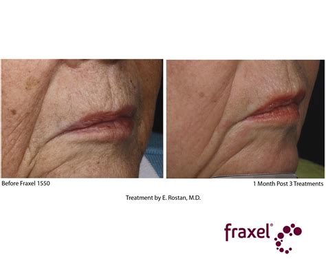 Fraxel Treatments At Long Island Garden City Great Neck Hamptons