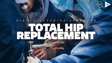 Direct Anterior Approach Total Hip Replacement By Edwin P Su Md