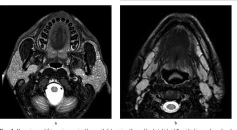 Figure 2 From Bilateral Parotid Swelling A Radiological Review