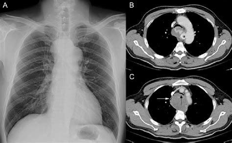 Preoperative Plain Film And Chest Computed Tomographic Ct Scan A