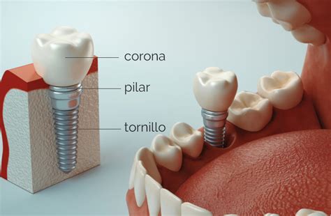 Partes Del Implante Dental Cu Les Son Abaden Hot Sex Picture