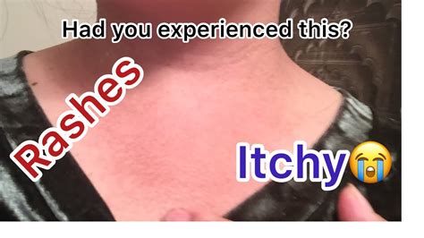 Itchy Neck Itchy Skin Home Remedy Ofw Youtube