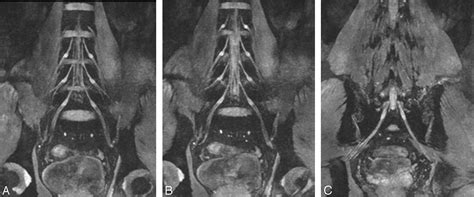 High Resolution Diffusion Weighted Mr Imaging Of The Human Lumbosacral