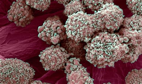 Others do have symptoms but, because those dull and persistent aching in your chest, ribcage, shoulders, or arms could be an early symptom of lung cancer. Leukaemia warning: Sweating at night could be a symptom of ...
