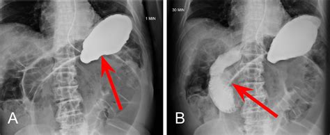 Cureus Simultaneous Sigmoid Volvulus And Small Bowel Obstruction A