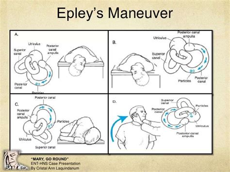 Epley Maneuver Instructions Left