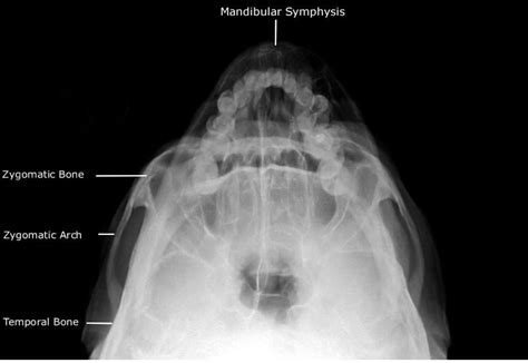 Radiographic Anatomy Of Facial Bones Postero Anterior Caldwell View Occipito Mental Om Waters