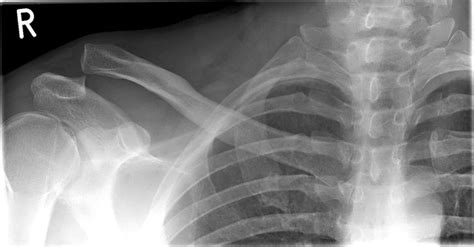 Ac3 Separation Of Collar Bone And Shoulder Flickr Photo Sharing