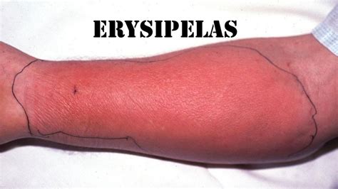 Erysipelas Definition Clinical Features And Complications Humainology