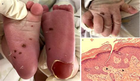 A Newborn With Dystrophic Epidermolysis Bullosa Self Improving And