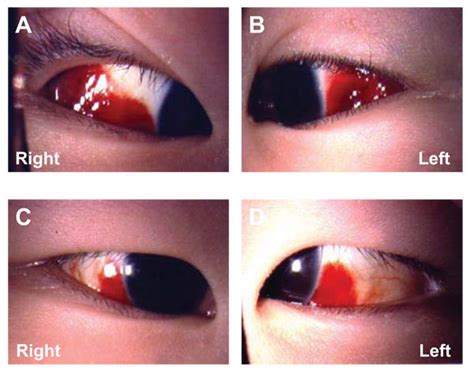 Subconjunctival Hemorrhage