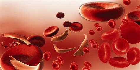 Anemia Falciforme Qué Es Causas Síntomas Tratable Y Más