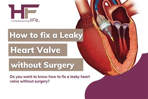 How To Fix A Leaky Heart Valve Without Surgery Healthfinder