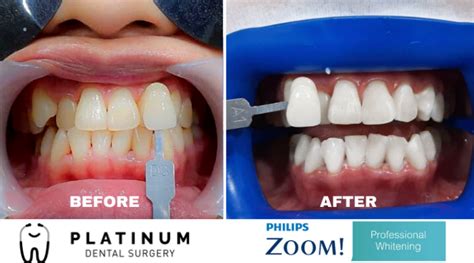 Teeth Whitening Platinum Dental Surgery