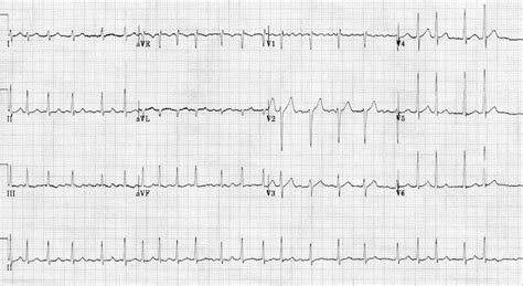 Atrial Fibrillation LITFL ECG Library Diagnosis 20116 Hot Sex Picture