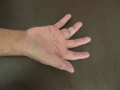 Hand And Wrist Hc Chang Orthopaedic Surgery