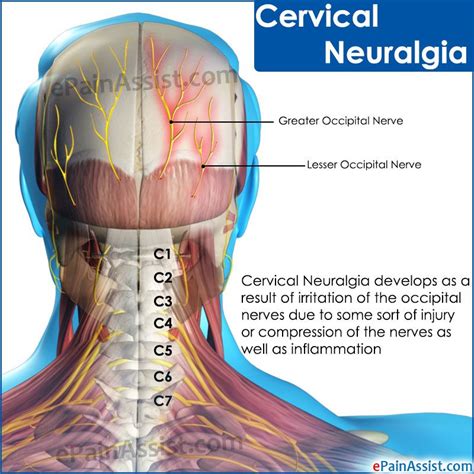 Cervical Neuralgiacausessymptomstreatmentdiagnosis Cervical