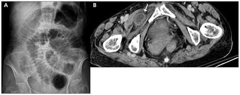 Small Bowel Obstruction Secondary To Obturator Hernia Cmaj