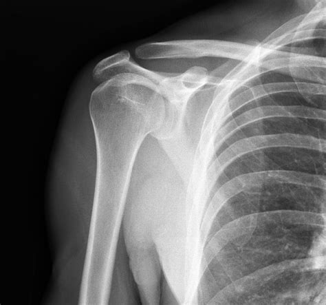 X Ray Of Shoulder Joint Irvings Law