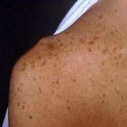 Brown Spots On Arms Shefalitayal