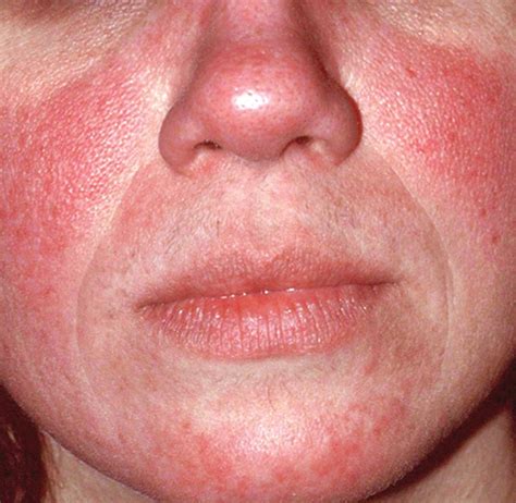 Rosacea Expert Recommends Treating Erythema Papulespustules