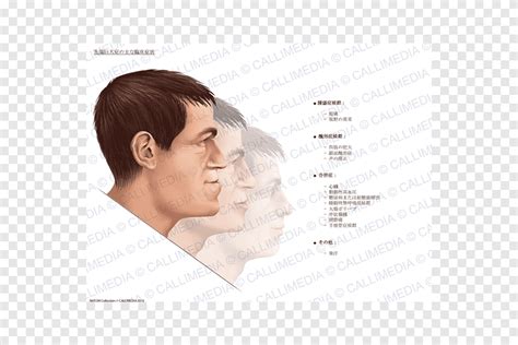 Acromegaly Symptom Gigantism Therapy Medical Sign Acromegalia Face