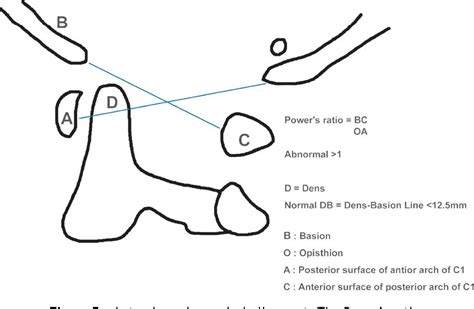 Figure 5 From Cervical Spine Clearance A Review Semantic Scholar
