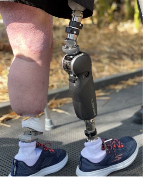 Knee Prosthesis Project Object Detection Dataset By