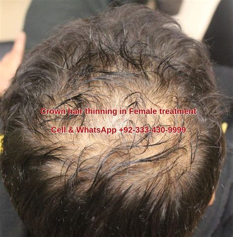 Female Hair Thinning At Crown Treating Women Hair Loss Lahore Pakistan