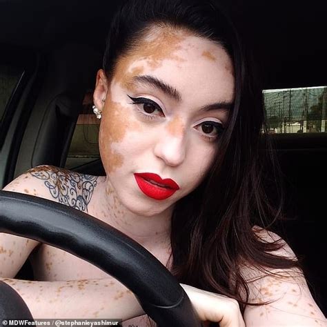 Woman With Vitiligo Reveals It Has Turned Her Almost Completely White