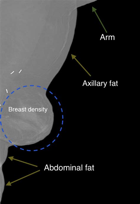 Mlo View Mammography With A Part Of The Arm And Axillary And Abdominal