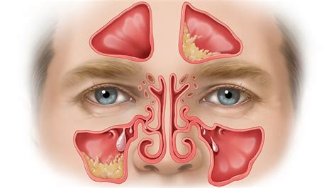 Fast Five Quiz Sinusitis With Nasal Polyps