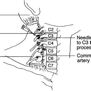 Cervical Plexus Block