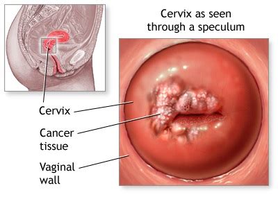 Cervical Cancer Symptoms Signs Treatment Diagnosis Prevention HealthMD