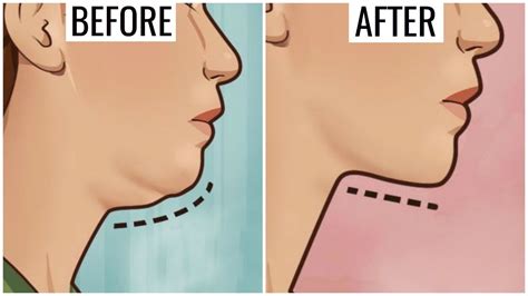 Get Rid Of Double Chin And Neck Fat Permanently How To Look Slim