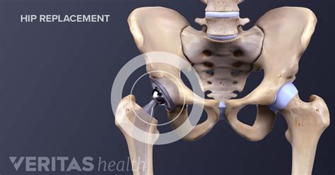 Total Hip Replacement Surgery Recovery