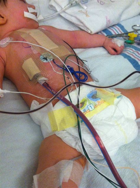 Cori Lou Begins A Well Monitored Recovery After Pediatric Open Heart