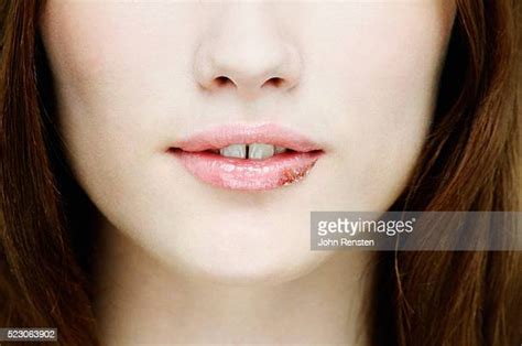 Cold Sores Photos And Premium High Res Pictures Getty Images