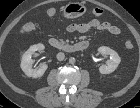 Transitional Cell Carcinoma Left Ureter Kidney Case Studies Ctisus