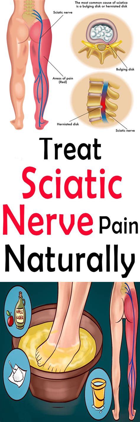 How To Get Rid Of Sciatic Nerve Pain In Leg Studiogphotodesign