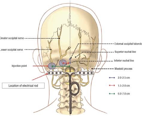 Nervus Occipitalis Neuralgie Oorzaak Wat Veroorzaakt Deze Zenuwpijn