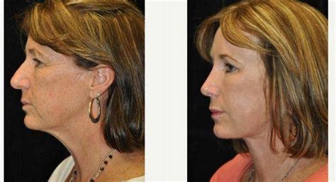 50 Year Old Woman Treated With Facelift By Dr Gary Motykie Md Los